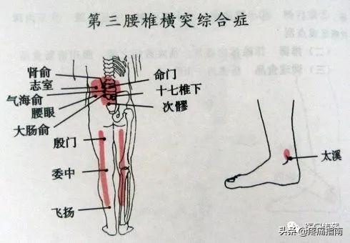 腰椎术后三个月神经粘连，解析与应对策略